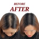 정수리 | 화성두피문신 출산탈모커버 엠자탈모 정수리 후기