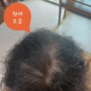현암로89번길 | 닷포유 smp 용인 죽전 탈모커버 추천 | 어머니 정수리 탈모 스트레스 해결 내돈내산 리얼후기