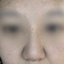 예술회관역 | 구월동 예술회관역하이코리프팅 솔직한 후기