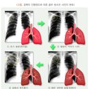 결핵진단비보장 특별약관과 약제내성결핵(슈퍼결핵포함)진단비보장 특별약관의 비교 이미지