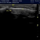 Tear within Extensor Dorsal Tendon , Distal Inter Phalangeal joint of Rt 4th finger 이미지