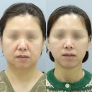 플래닛성형외과의원 | 안면거상후기, 18년차 전문의가 말하는 진실 [병원, 수술]