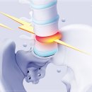 고려보조기 이미지