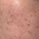 수부지 피부 때문에 찾다가 사용해본 히알루론산토너 로션 후기