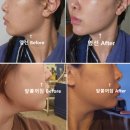도보소프트 | 청담피부과 실루엣소프트+민트 맞춤 실리프팅 내돈내산 후기