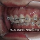 대화메디피아(주) | [연세참예쁜치과] 동탄치과상담 앞니 부분교정 동탄교정후기 2 (앞니 틀어짐, 과개교합)
