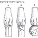 하지정맥류의 발생기전... -순천 아나파정맥통증의원 하지정맥류클리닉 이미지