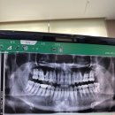신경치료, 충치치료 지르코니아 크라운, 금 크라운 후기 연세휴치과의원 동부이촌점 신경치료 장점