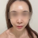 위례 피부관리 좁쌀여드름 트러블 케어 잘하는 프롬미 위례점