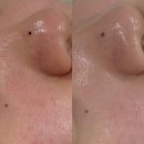 아리랑로 | [성북 피부관리] 모공 블랙헤드 피지관리 포어힐 제대로 받온 “모브스킨” 솔직 후기