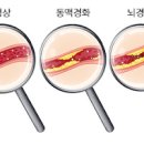 급성 뇌경색 전조 원인 초기 진단 스텐트 삽입술 후유증 예방 이미지