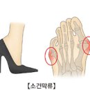 새끼발가락 통증 원인 (소건막류) 이미지