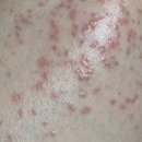 복약국 | 닥터나우 비대면 진료 추천 겨울철 한랭두드러기 콜린성두드러기 비대면 약처방 후기