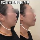 얼태기가 고민일때는?광주이중턱리프팅 눈바래다 후기