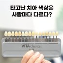 이화여자대학교 임상치의학대학원 | 대구치과, 대구치아미백 vs 라미네이트 (1)