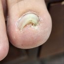 동두천 파고드는 내성발톱 비포 에프터 확실한 네일애반하다 네일 아트 내성발톱 무좀 발각질 문제성발