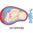 조기 양막 파열[Premature rupture of membranes]여성질환 이미지