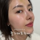 아셀헤어모드 | 역삼역피부과 줄기세포주사 실펌엑스+엑소좀 트리플 조합 하이엔드 시술 후기 (통증, 멍, 경과)