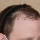 원영상의학과의원(The One MRI Clinic) | 움찬 모발이식 의원 I Fut+Fue 5000 hairs Change Process 12 months Before After