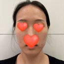 수한의원 | 강남한의원 패인흉터치료 새살침 3회차 솔직후기