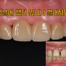 뉴욕굿모닝치과의원 네이버블로그