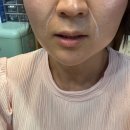 포레스트성형외과 | 압구정로데오역 피부과 팔자주름 포레스트리프팅 후기