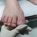 지인메디칼 | 내성발톱 통증 드디어 해결 ! 내성발톱 치료 잘하는 구로역 서울늘봄메디칼의원