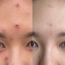 역삼약국 | 강남 역삼피부과 이마, 미간흉터 제거 새살침 1회차 일주일 경과 내돈내산 후기