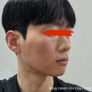 제5회 청주연묵회전 | 청주 ‘S' 의원 방문기 11편 | 지루성 피부염 피부과 5회차 시술 후 피부 상태 후기
