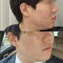 재생한의원 | 신중동역 여드름 한의원 바이오필링 재생관리 후기