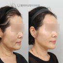 빌리프성형외과의원 | 빌리프 성형외과 안면거상후기 보다 중요한 것