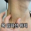 목 임파선 부었을 때 멍물 위치에 따른 원인 증상 치료 관리 예방법 이미지