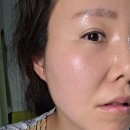 다온다옴 | 부산 서면 피부과 :: 온다리프팅 후기 (효과, 통증)