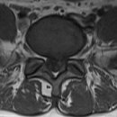 허리디스크 MRI보는 법. T1, T2, Sagittal view, axial view 이미지