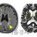 육류 단백질 과다섭취→ 뇌경색 위험 높이는 메커니즘 규명 이미지