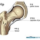 대퇴골두무혈성괴사, 근육과 인대 보존하는 인공관절수술로 치료. 이미지