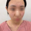 대지한의원 | 수원 편평사마귀제거 한의원 무제한 당일 1-2일차