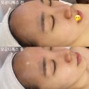 [위례 피부관리] 모공디톡스로 깐달걀피부가 되,, _ 올가드림뷰티 송파위례점