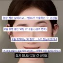 케이성형외과의원 | 더케이플러스성형외과 요정귀 필러 후기 정말 괜찮을까