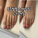 수지네일 - 거제시 | 천안 문제성발톱 전문 수지네일 꼼꼼한 발톱 스케일링 후기