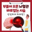 고령층 '뇌동맥류' 시술도 '혈전' 걱정 없다 이미지