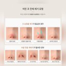 한코교역(주) | 코 전체제거 후기 코끝 연골 재배치