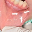 가야치과병원 | 입술 안쪽 점액낭종 원인 및 증상과 제거를 위한 치과 병원 수술 치료 후기 및 재발가능성