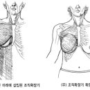 [가슴성형/유방재건] 유방재건술 이미지