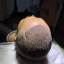 메르하바 | 30대 회사원 터키 모발이식 후기 디시