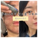 송파나루역피부과 골드PTT 여드름치료 찐후기!