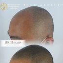 오직 스칼프 이미지