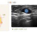 유방 결절 원인 5가지 및 : 가슴 멍울(몽우리) 낭종(물혹 혹) 섬유선종(양성종양) 유두종 지방종 이미지