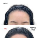 헤어라인하면 얼굴 완전 작아집니다!!(헤어라인=29만) 이미지