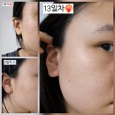 화접몽한의원 | 노원 서울편평사마귀성지 화접몽한의원 거우침으로 편사 제거 후기